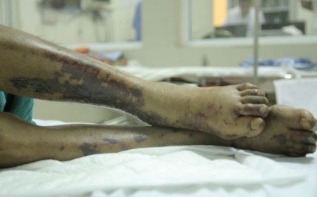 ĐỀ PHÒNG BỆNH CHẾT NGƯỜI TỪ VIỆC ĂN TIẾT CANH LỢN ĐÓN TẾT