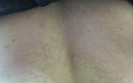 Mẩn Ngứa Da Do Giun Sán Cách Phát Hiện Nhiễm Sán Trong Máu Gây Ngứa