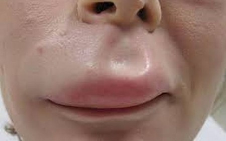 Tại Sao Nhiễm Giun Sán Lại Khiến Da Bị Ngứa Rát Nổi Mẩn Liên Tục?