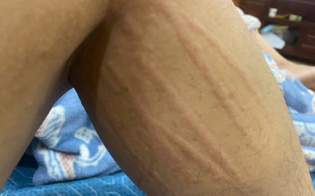 Mẩn Ngứa Kéo Dài Có Phải Do Ấu Trùng Giun Sán Chó Mèo?
