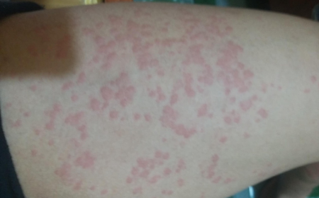 Mẩn Ngứa Nhiều Năm, Xét Nghiệm Sán Chó Âm Tính: Nguyên Nhân Do Đâu?