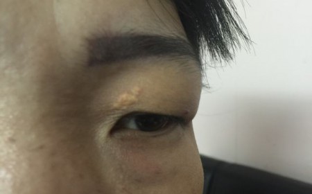 Mắt Bị Mờ Do Giun Sán Dấu Hiệu Nhận Biết Và Thời Gian Điều Trị