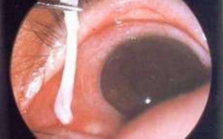 Mắt Bị Mờ Không Loại Trừ Nguyên Nhân Do Nhiễm Bệnh Giun Sán