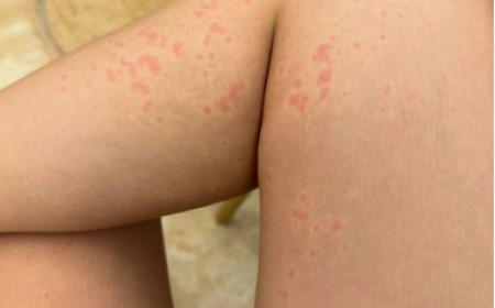 Ngứa Da, Nổi Mẩn Kéo Dài Có Phải Do Nhiễm Ký Sinh Trùng Giun Sán?