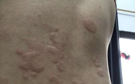 Ngứa Da, Nổi Mề Đay Dai Dẳng: Có Liên Quan Ấu Trùng Giun Sán?