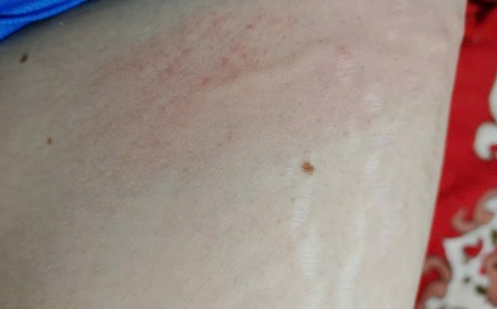 Ngứa da, nổi mề đay kéo dài: Cảnh báo nhiễm giun sán Toxocara