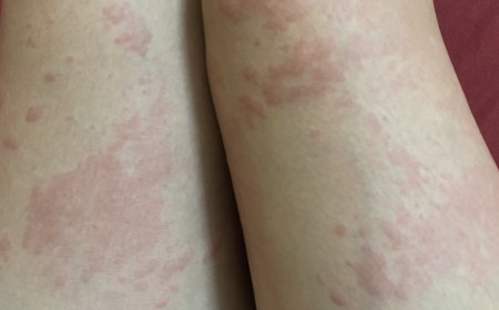 Ngứa Da Nổi Mề Đay Kéo Dài – Coi Chừng Nhiễm Ấu Trùng Giun Sán! Tiến sĩ BS Nguyễn Hằng Lan Tư Vấn