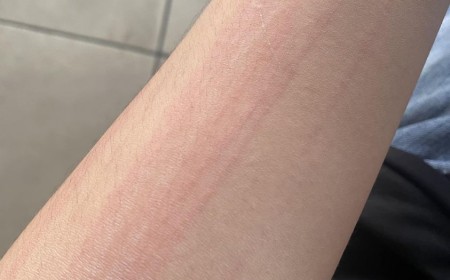 Ngứa Khắp Người, Có Phải Nhiễm Sán Chó?