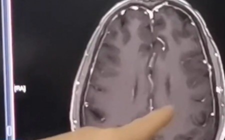 Người Đàn Ông Não Chi Chít Sán Chỉ Vì Một Món Ăn