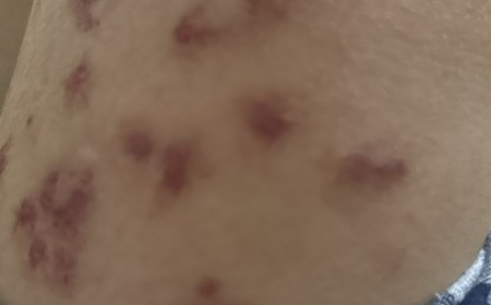 Nhận Biết Các Thay Đổi Trên Da, Khối U Và Màu Da