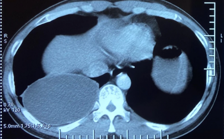 Nhiễm Ấu Trùng Sán Dây Chó Ký Sinh Tại Phổi