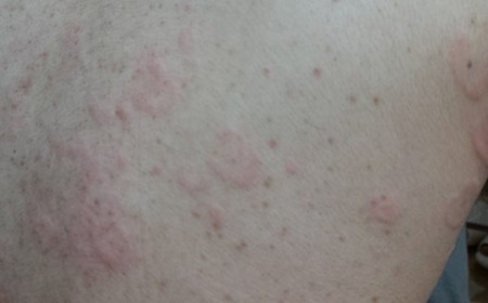 Nhiễm Bệnh Sán Chó Mèo Toxocara Vì Thói Quen Ăn Uống
