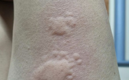 Nhiễm Sán Chó Toxocara: Tại Sao Lại Gây Ngứa, Mề Đay Kéo Dài? Nguyên Nhân Và Cách Điều Trị
