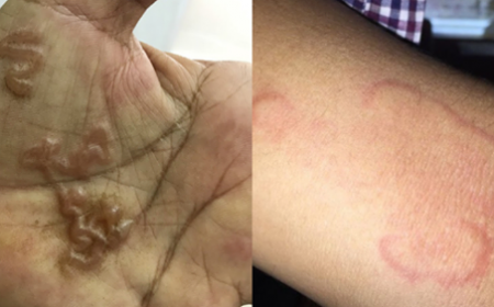 SỐ NGƯỜI NHIỄM GIUN SÁN Ở KHÁNH HÓA