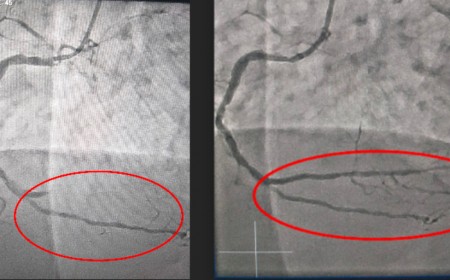 NGƯỜI PHỤ NỮ SUÝT CHẾT VÌ BỆNH NHỒI MÁU CƠ TIM