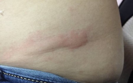 Những điều cần biết về bệnh giun đũa chó mèo