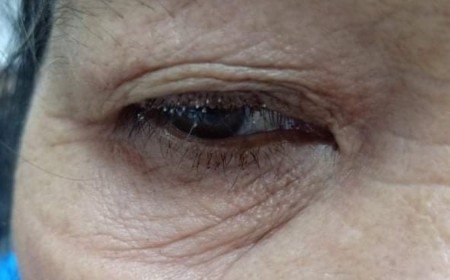 NGƯỜI PHỤ NỮ BỊ RẬN MU BÁM MI MẮT