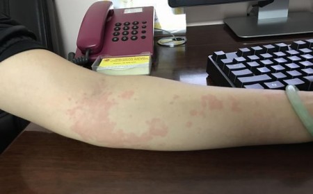 Sán chó Những Dấu Hiệu Của Bệnh Sán Chó Chớ Nên Xem Thường