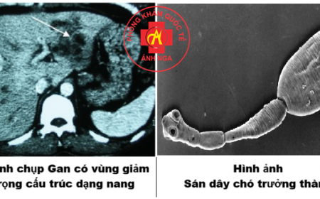 Sán Dây Chó Echinococcus: Nguyên Nhân, Điều Trị Và Phòng Ngừa