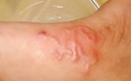 Bệnh Sán Dây | Ấu Trùng Sán Lợn Có Nguy Hiểm Không