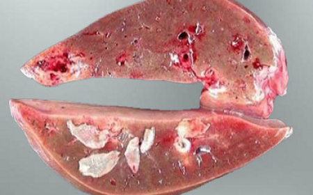 Sán Lá Gan Lớn: Nguyên Nhân Lây Nhiễm, Triệu Chứng Và Cách Điều Trị Hiệu Quả