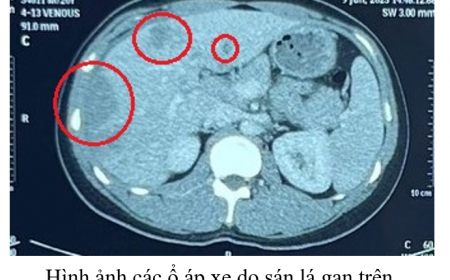 Sán Lá Gan: Phân Biệt Sán Lá Gan Nhỏ Và Lớn, Con Đường Lây Nhiễm