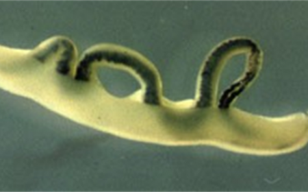 BỆNH SÁN MÁNG VÀ CÁC BIẾN CHỨNG