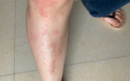 Sán Máng (Schistosomiasis): Nguyên Nhân Lây Truyền Và Cách Điều Trị Hiệu Quả