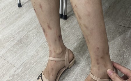 NGƯỜI PHỤ NỮ VUI MỪNG  SAU KHI ĐƯỢC TRỊ KHỎI BỆNH SÁN CHÓ TOXOCARA