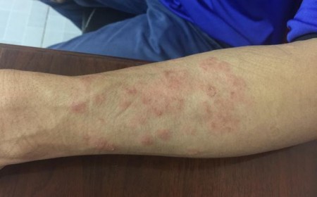 Tôi Muốn Trị Dứt Điểm Bệnh Giun Đũa Chó Thì Phải Làm Sao