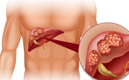 Tổng Quan Về Bệnh Viêm Gan