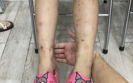 Trẻ Ngứa Da Kéo Dài: Cảnh Giác Ấu Trùng Giun Đũa Chó Mèo