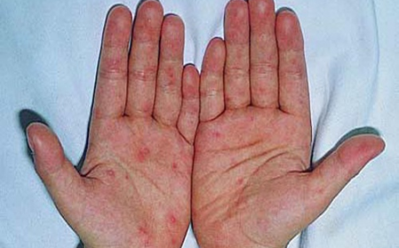 Triệu Chứng Của Bệnh Viêm Da Tay - Chân, Chẩn Đoán và Cách Điều Trị