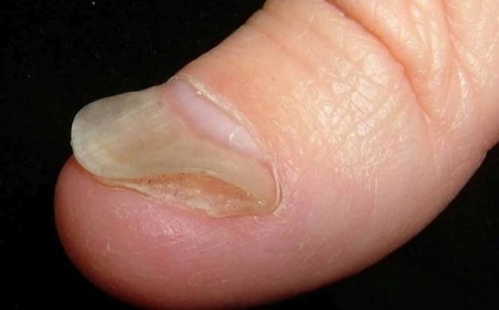 Trước Khi Ung Thư Đến, Tay Chân Thường Có 4 Dấu Hiệu Này