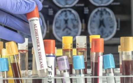 98% CÓ THỂ PHÁT HIỆN BỆNH ALZHEIMER KHI XÉT NGHIỆM MÁU