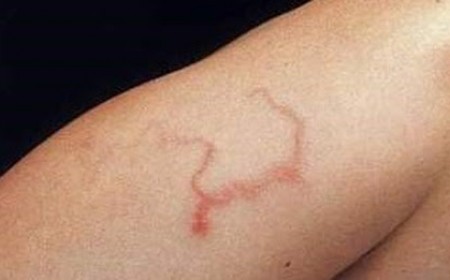 XÉT NGHIỆM BỆNH GIUN LƯƠN