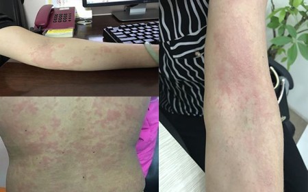 Viêm Da Dị Ứng Kéo Dài Tôi Chỉ Mong Tìm Được Nguyên Nhân Để Chữa Trị.