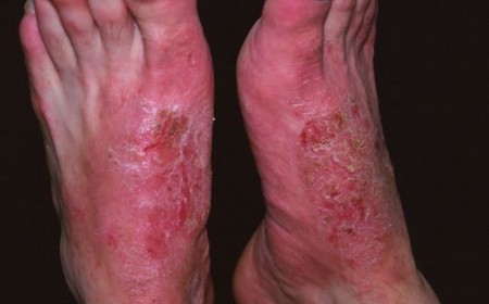 Viêm Da Tiếp Xúc