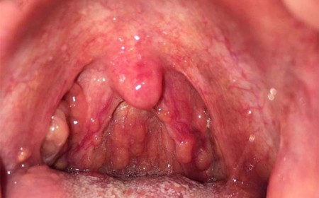 VIÊM HỌNG HẠT LÀ GÌ ? NGUYÊN NHÂN VÀ CÁCH ĐIỀU TRỊ