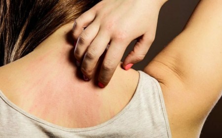 CẢNH BÁO UNG THƯ NẾU CÓ TRIỆU CHỨNG NGỨA DA