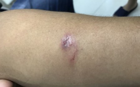 Giun Đũa Chó Nguyên Nhân Triệu Chứng Điều Trị Giun Đũa Chó