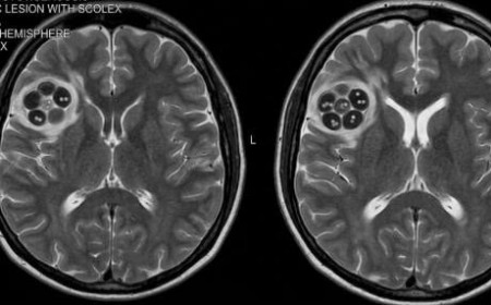 Xét Nghiệm Và Điều Trị Sán Dây Chó Echinococcus Hiệu Quả 