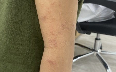 BÉ VIÊM NÃO DO NHIỄM GIUN ĐŨA CHÓ MÈO