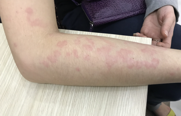 Bệnh sán chó: Những điều cần biết về bệnh sán chó ở Toxocara