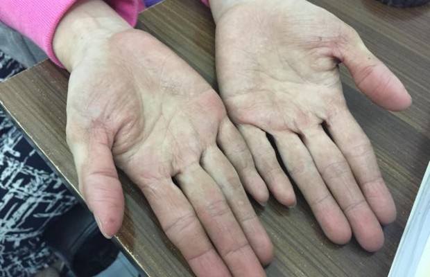 Dấu hiệu nào nhận biết viêm da cơ địa do nhiễm giun sán?