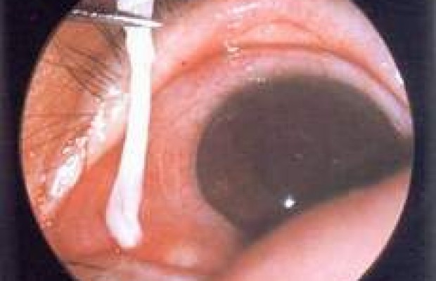 Mắt Bị Mờ Không Loại Trừ Nguyên Nhân Do Nhiễm Bệnh Giun Sán