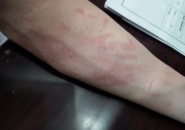 10 Dấu Hiệu Bạn Có Thể Có Ký Sinh Trùng