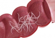 GIUN LƯƠN - TRIỆU CHỨNG VÀ DẤU HIỆU