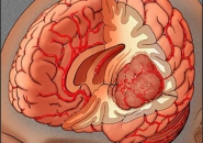 8 DẤU HIỆU VÀ TRIỆU CHỨNG CẢNH BÁO BỆNH U NÃO