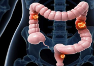 TẦM SOÁT UNG THƯ ĐẠI TRỰC TRÀNG MANG LẠI NHIỀU LỢI ÍCH